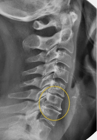 Osteocondrose da columna cervical nun x -ray